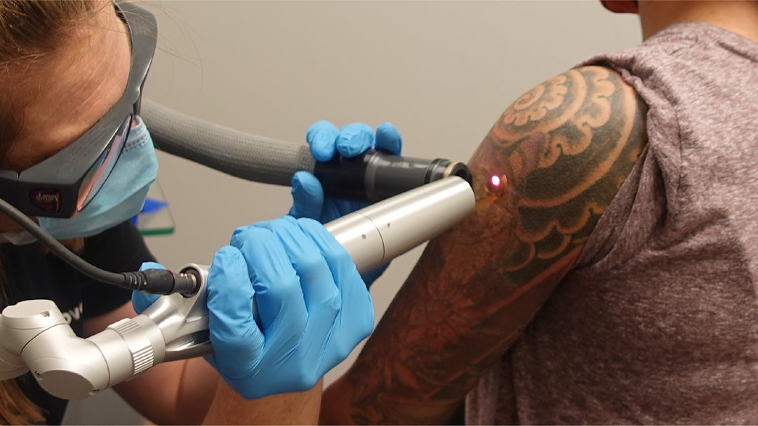 Removery Tattoo Removal & Fading tattoo work — photo 2