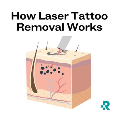 Removery Tattoo Removal & Fading — tattoo studio near Altamonte Springs