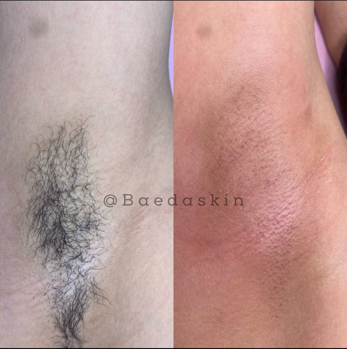 BaedaSkin Brazilian Waxing And Vajacials — photo 2