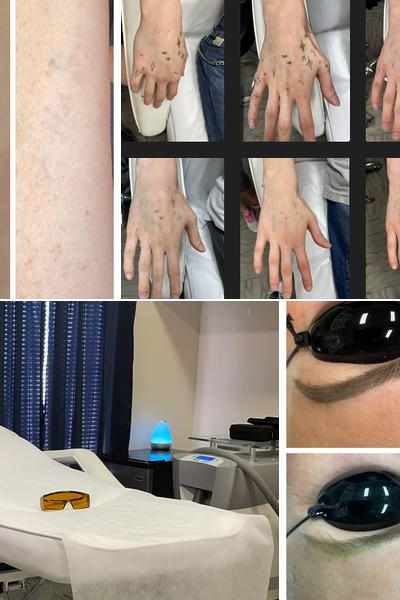 Shipers Laser Tattoo Removal Center Dallas in Allen, TX