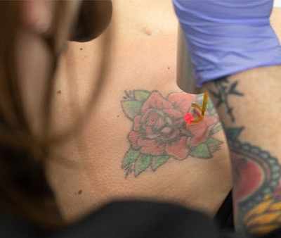 Removery Tattoo Removal & Fading in Chesterfield, MO