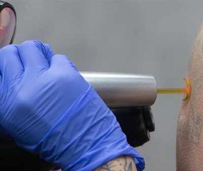 Removery Tattoo Removal & Fading in King of Prussia, PA