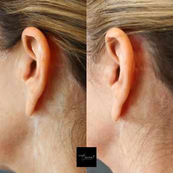 Medical Body Blending in Lakeway, TX