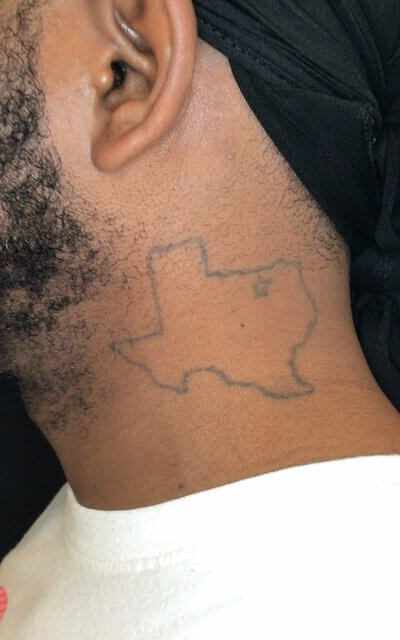 Removery Tattoo Removal & Fading in Mesquite, TX