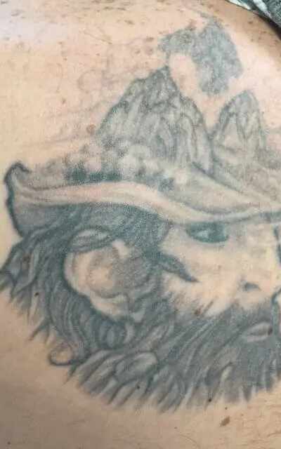 Removery Tattoo Removal & Fading in Naperville, IL