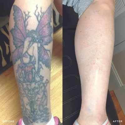 Removery Tattoo Removal & Fading in Oceanside, CA