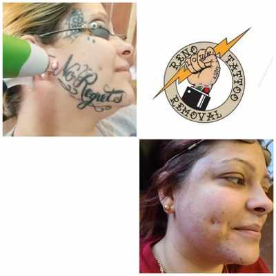Reno Tattoo Removal in Reno, NV