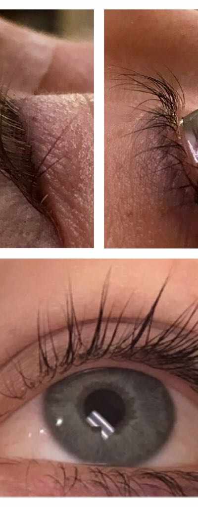 SWIFT Hair Removal in Seattle, WA